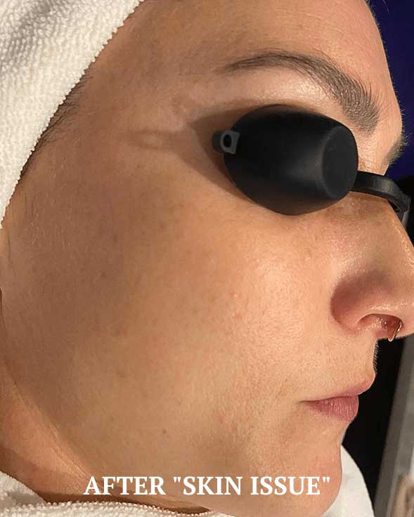 After treatment photo showing improved skin clarity and reduced pigmentation at Bauhinia Wellness Spa.