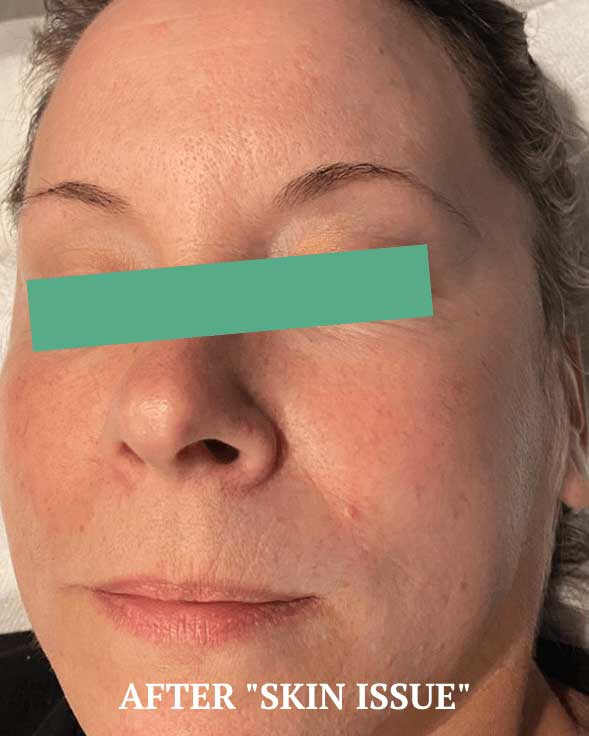 Clearer skin and improved texture after SQT® Bio-Microneedling at Bauhinia Wellness Spa.