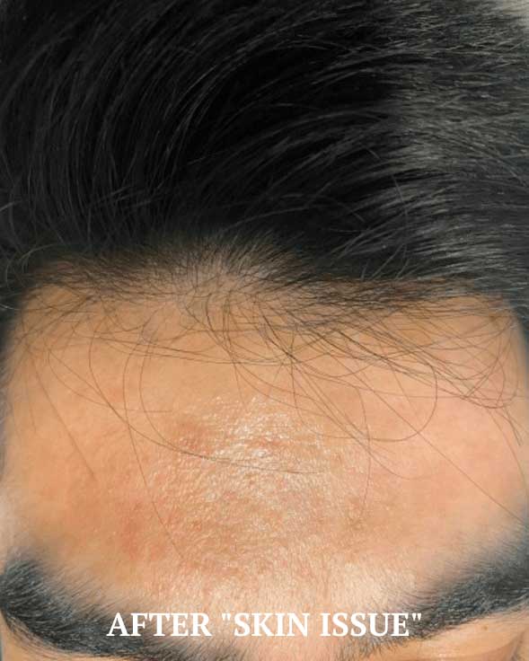 Noticeable skin healing and glow after SQT® Bio-Microneedling treatment at Bauhinia Wellness Spa.