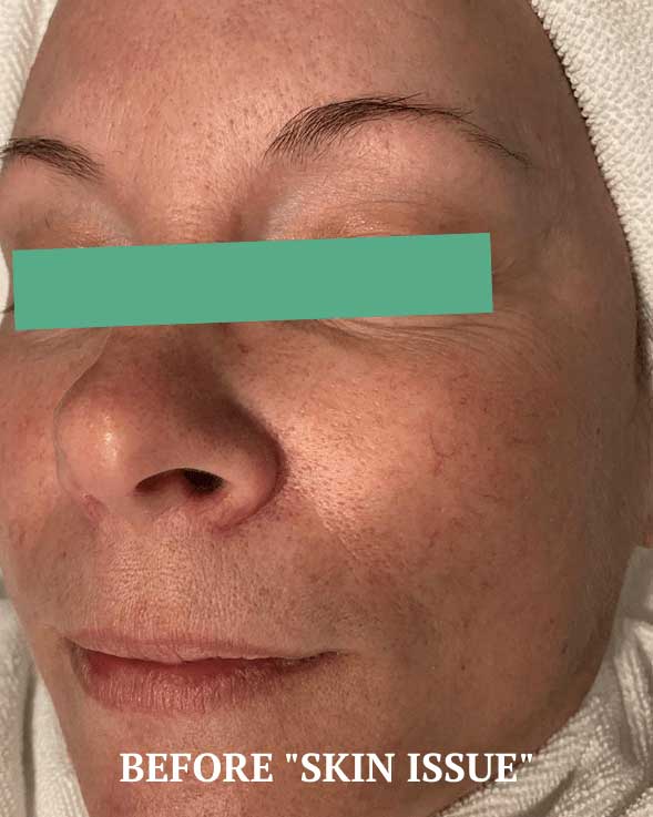 Before treatment photo showing visible skin texture and pigmentation concerns at Bauhinia Wellness Spa.