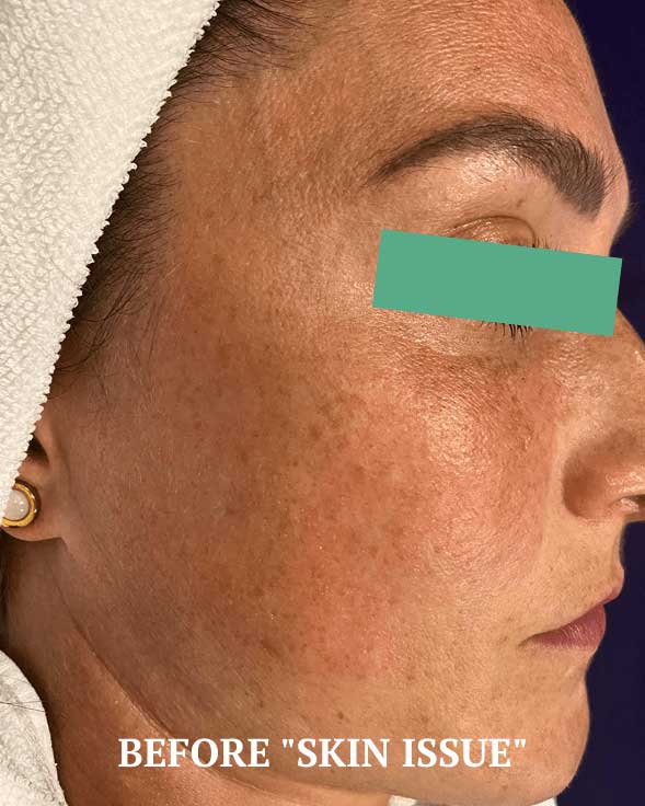 Before treatment photo showing skin pigmentation and texture at Bauhinia Wellness Spa.